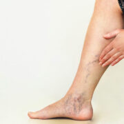 Varicose veins in pregnancy