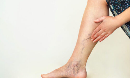 Varicose veins in pregnancy